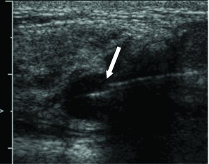 Speed Error associated with a needle