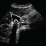GALLBLADDER WITH ACOUSTIC SHADOWING FROM A GALLSTONE