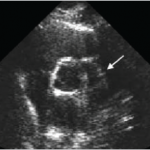 SPURIOUS SECOND AORTIC VALVE ROOT CAUSED BY GRATING LOBE ARTIFACT
