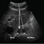 REFRACTION ARTIFACT CREATING A "SECOND" ABDOMINAL AORTA