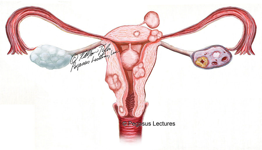 uterinefibroids_1_4blog