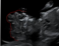 Acrania Visualized in Ultrasound Scan